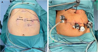 Feasibility of Roux-en-Y Gastric Bypass with the novel robotic platform HUGO™ RAS